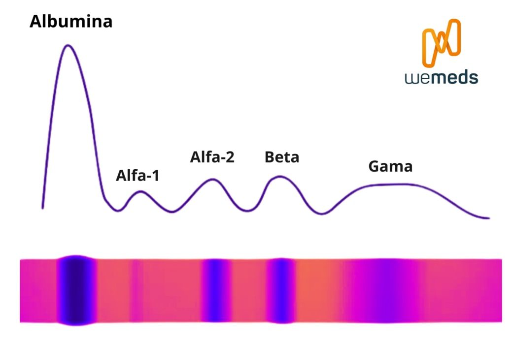 Como interpretar a Eletroforese de Proteínas Séricas?