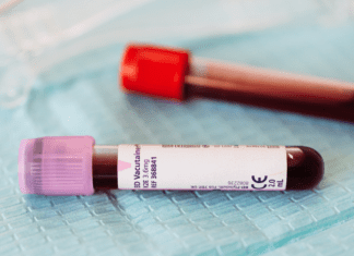 Exame de crioglobulinas: quando solicitar, como interpretar e quais doenças investigar Tubos de coleta de sangue sobre laudo laboratorial