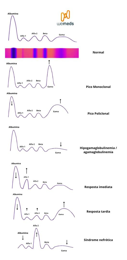 Como interpretar a Eletroforese de Proteínas Séricas?