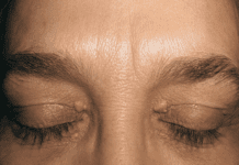 O que é Xantelasma e qual a relação com a Dieta Carnívora?