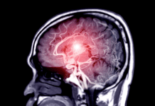 Escala Hunt-Hess: como calcular, interpretar e prever gravidade da hemorragia subaracnoide Imagem de hemorragia subaracnoidea causada por ruptura de aneurisma cerebral usada na avaliação pela Escala Hunt-Hess