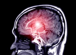 Escala Hunt-Hess: como calcular, interpretar e prever gravidade da hemorragia subaracnoide Imagem de hemorragia subaracnoidea causada por ruptura de aneurisma cerebral usada na avaliação pela Escala Hunt-Hess