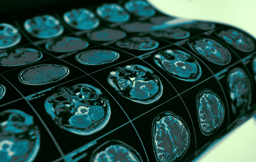 Como utilizar a Escala HUNT-HESS em pacientes com Hemorragia Subaracnoidea