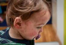 Casos de Sarampo no Rio de Janeiro são esporádicos, afirma Ministério da Saúde Emergência em saúde pública