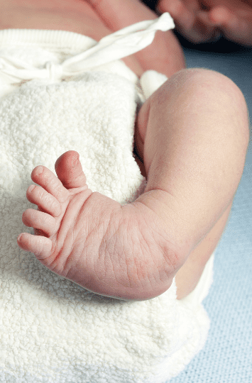 tratamento do pé torto congênito