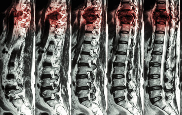 exames de imagem da coluna indicando síndrome de compressão medular neoplásica com potencial choque neurogênico