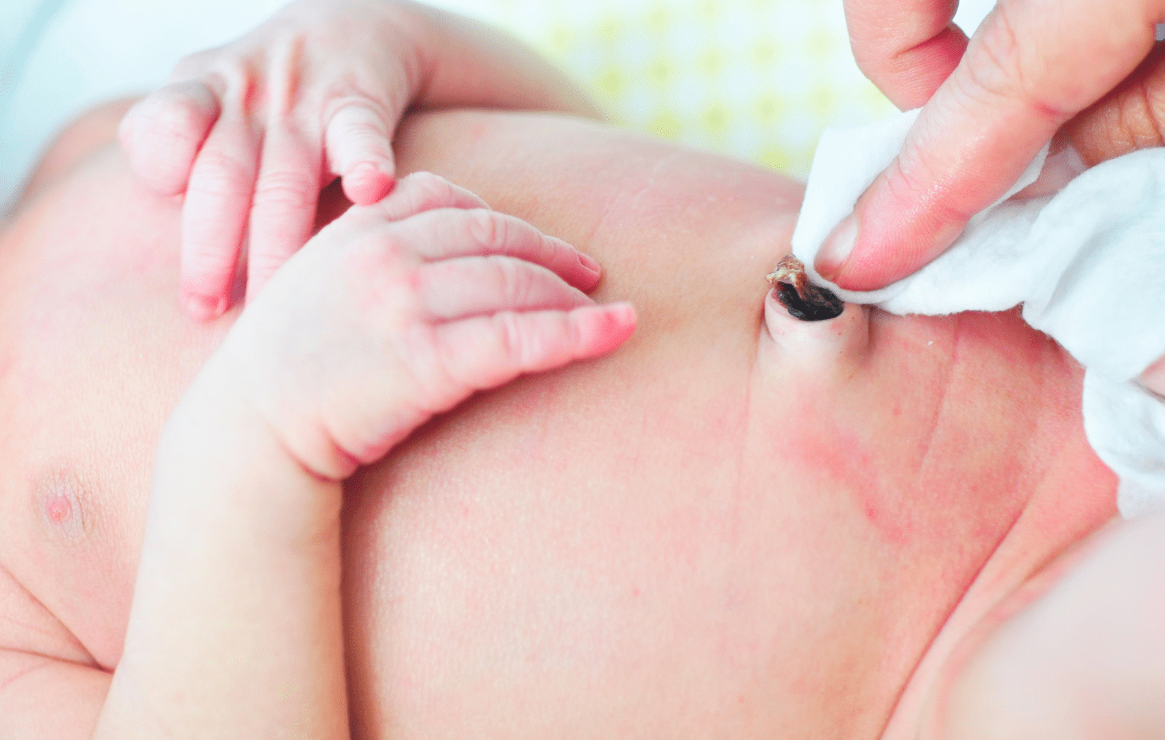 sal no Granuloma Umbilical