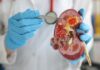 Uropatia obstrutiva infecciosa: como reconhecer e tratar a pielonefrite obstrutiva médico segurando um rim, representando doença renal, como a uropatia obstrutiva infecciosa