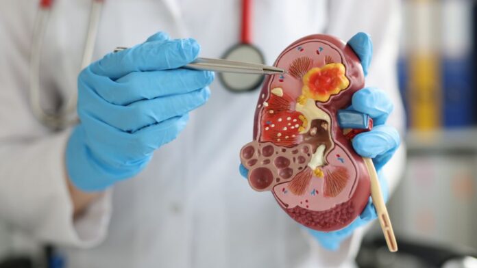 doença renal rim médico segurando um rim, representando doença renal, como a uropatia obstrutiva infecciosa
