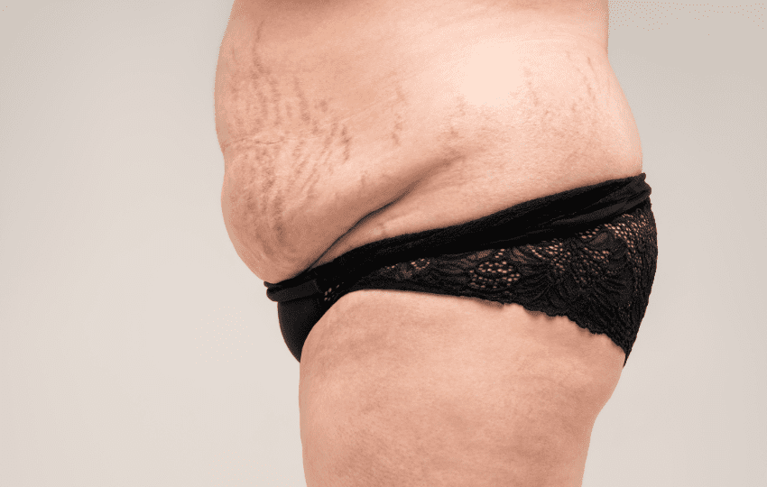 síndrome de cushing