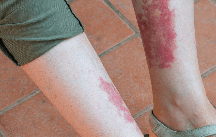 Avacopan: antagonista do receptor C5a no tratamento da vasculite associada ao ANCA