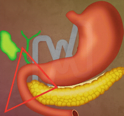 Síndrome de Zollinger-Ellison, gastrinoma, hipergastrinemia, úlcera péptica refratária