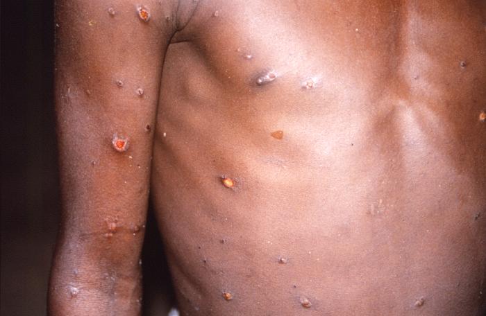 lesões cutâneas de mpox em paciente durante surto na República Democrática do Congo