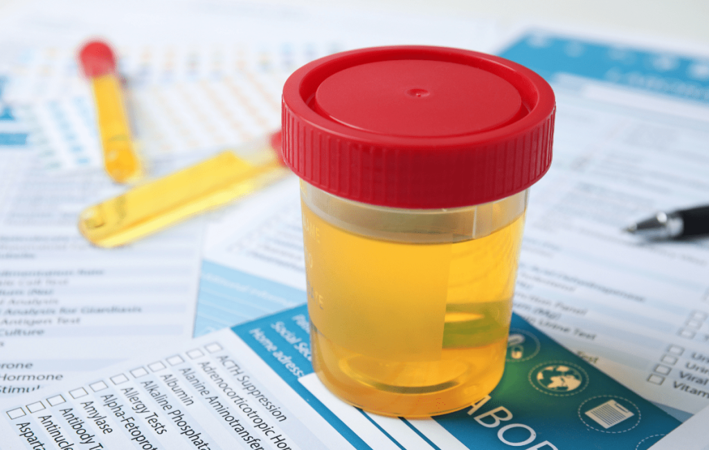 frasco com urina coletada para avaliação laboratorial de Esterase leucocitária urinária