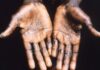 Mpox 2026: o que se sabe sobre a nova variante (clado Ib)? Lesões cutâneas de mpox nas palmas das mãos, padrão característico da doença