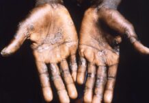 Mpox 2026: o que se sabe sobre a nova variante (clado Ib)? Lesões cutâneas de mpox nas palmas das mãos, padrão característico da doença