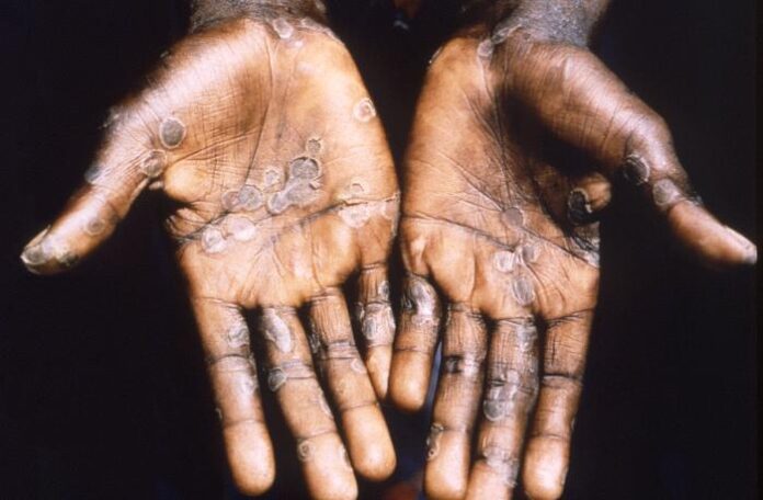 Lesões cutâneas de mpox nas palmas das mãos, padrão característico da doença