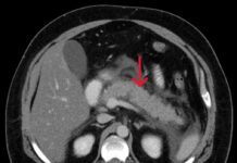Escore de Ranson para Pancreatite Aguda: saiba como utilizar Tomografia computadorizada de pancreatite aguda, avaliada pelos critérios de ranson