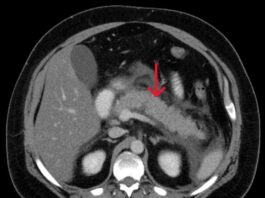 Tomografia computadorizada de pancreatite aguda, avaliada pelos critérios de ranson