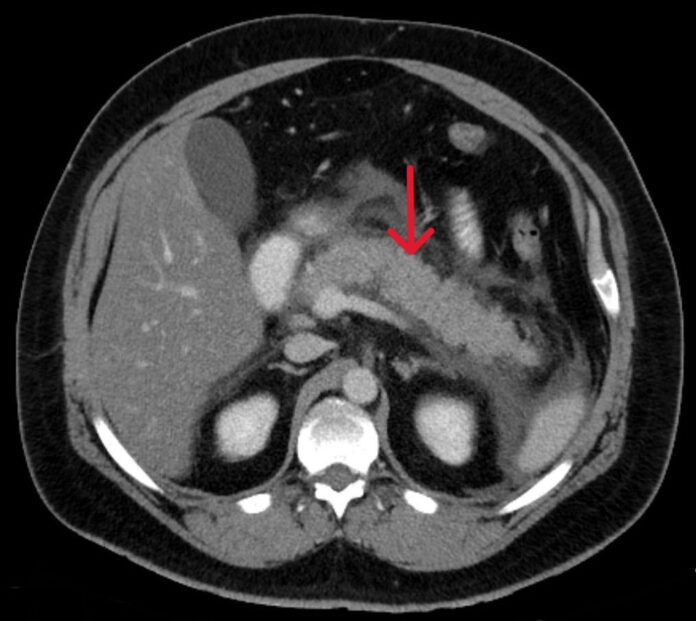 Tomografia computadorizada de pancreatite aguda, avaliada pelos critérios de ranson