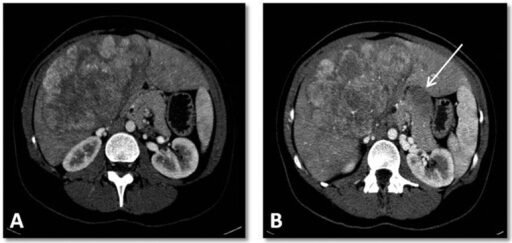 Tomografia computadorizada abdominal de um paciente com carcinoma hepatocelular fibrolamelar.