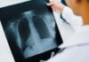 Hantavírus: como reconhecer, diagnosticar e tratar a hantavirose Profissional de saúde analisando exame pulmonar em paciente com hantavirose
