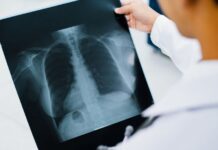 Hantavírus: como reconhecer, diagnosticar e tratar a hantavirose Profissional de saúde analisando exame pulmonar em paciente com hantavirose