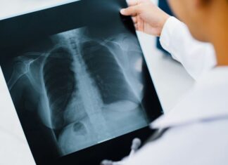 Hantavírus: como reconhecer, diagnosticar e tratar a hantavirose Profissional de saúde analisando exame pulmonar em paciente com hantavirose