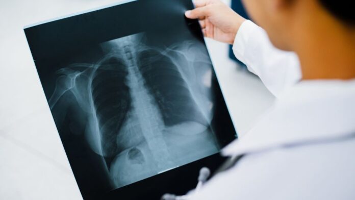 Profissional de saúde analisando exame pulmonar em paciente com hantavirose