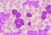 SUS incorpora venetoclax + azacitidina para leucemia mieloide aguda