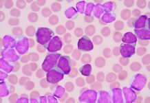 SUS incorpora venetoclax + azacitidina para leucemia mieloide aguda