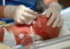 Reanimação neonatal: algoritmo atualizado da SBP recém-nascido em UTI neonatal sendo avaliado quando a necessidade de reanimação neonatal pelo algoritmo atualizado da SBP