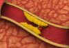 FDA aprova enlicitida, primeiro inibidor oral da PCSK9 para redução do colesterol LDL arteriosclerose, uma consequência da hipercolesterolemia, que pode ser prevenida com o tratamento com enlicitida