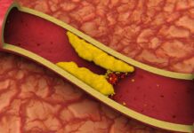 FDA aprova enlicitida, primeiro inibidor oral da PCSK9 para redução do colesterol LDL arteriosclerose, uma consequência da hipercolesterolemia, que pode ser prevenida com o tratamento com enlicitida
