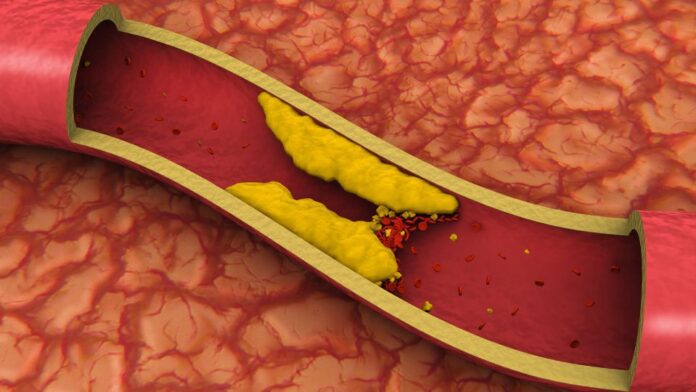 arteriosclerose, consequência clínica da hipercolesterolemia1 arteriosclerose, uma consequência da hipercolesterolemia, que pode ser prevenida com o tratamento com enlicitida