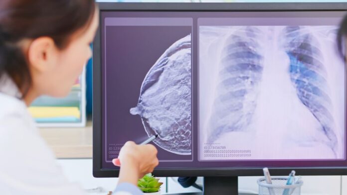 Médica avaliando exames de câncer de mama para indicação de tratamento com inlunestranto (Inluriyo®).