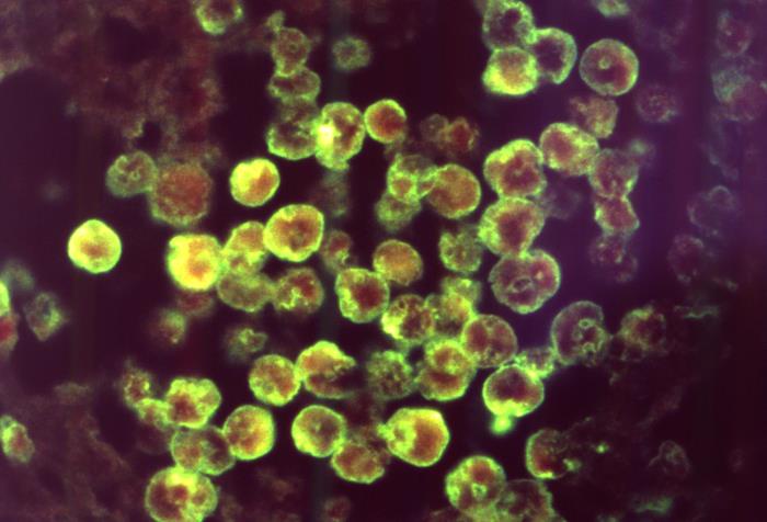 Amostra de tecido cerebral com marcação com anticorpos fluorescentes utilizada em um teste de imunofluorescência para a detecção de Naegleria fowleri em um caso de meningoencefalite amebiana primária (MAP). 