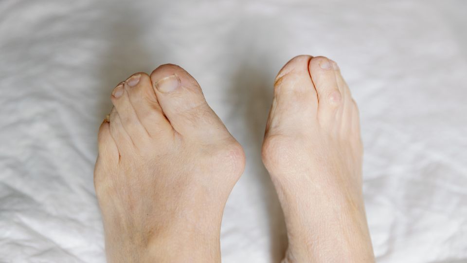 halux valgo, malformação presente em mais de 95% dos pacientes com fibrodisplasia ossificante progressiva