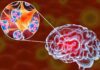 Meningoencefalite amebiana primária: a infecção cerebral fatal causada pela Naegleria fowleri imagem representativa da infecção cerebral causada pela Naegleria fowleri, a Meningoencefalite amebiana primária