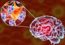 Meningoencefalite amebiana primária: a infecção cerebral fatal causada pela Naegleria fowleri imagem representativa da infecção cerebral causada pela Naegleria fowleri, a Meningoencefalite amebiana primária