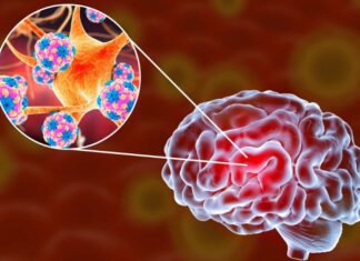 Meningoencefalite amebiana primária: a infecção cerebral fatal causada pela Naegleria fowleri imagem representativa da infecção cerebral causada pela Naegleria fowleri, a Meningoencefalite amebiana primária