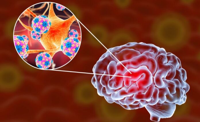 imagem representativa da infecção cerebral causada pela Naegleria fowleri, a Meningoencefalite amebiana primária