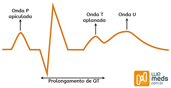 Alterações no ECG da hipocalemia